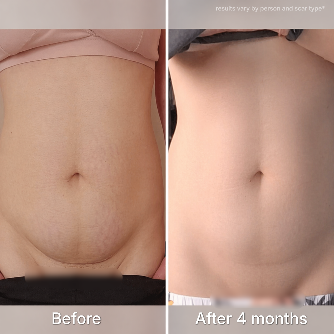 C-Section Scar Therapy Stick