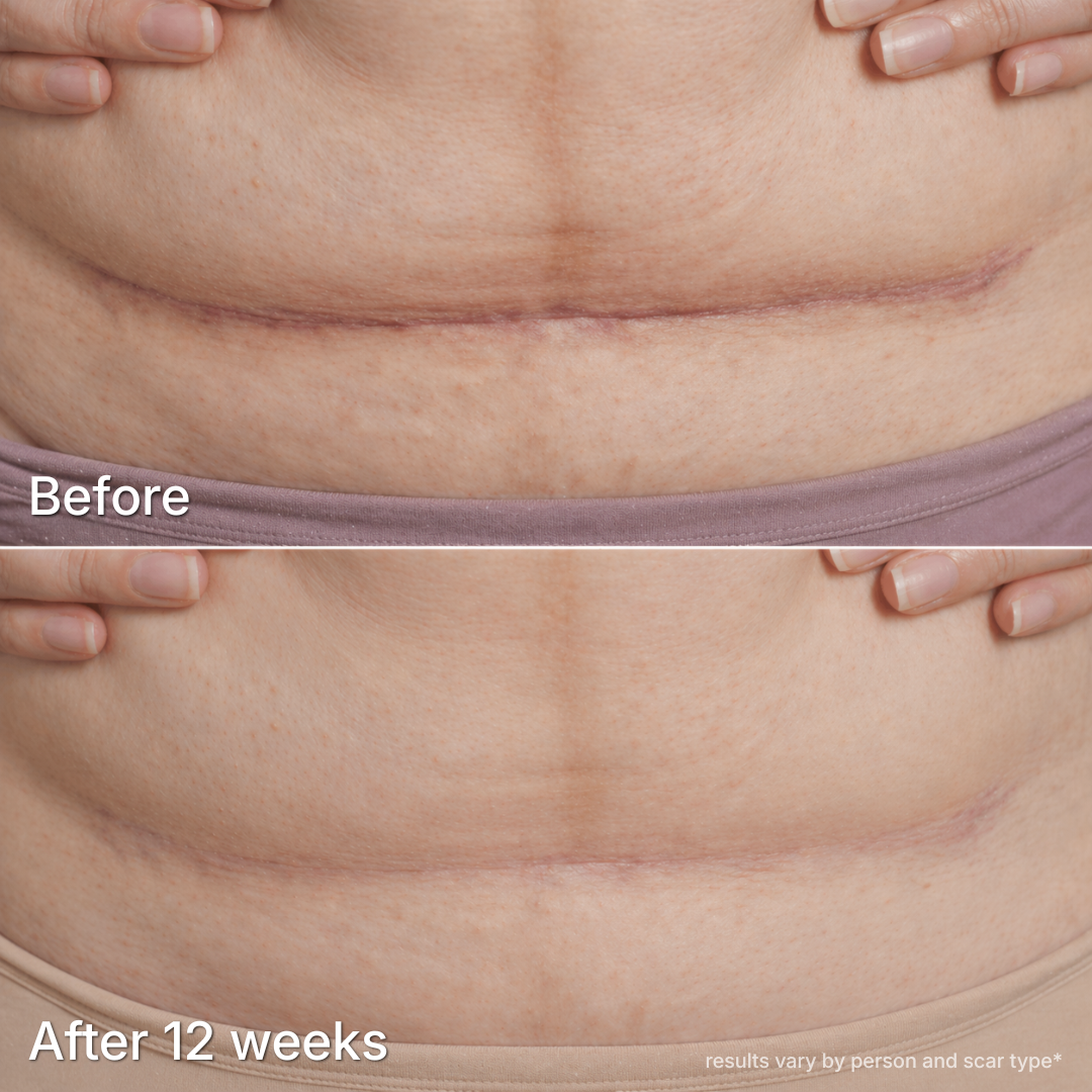C-Section Scar Therapy Stick