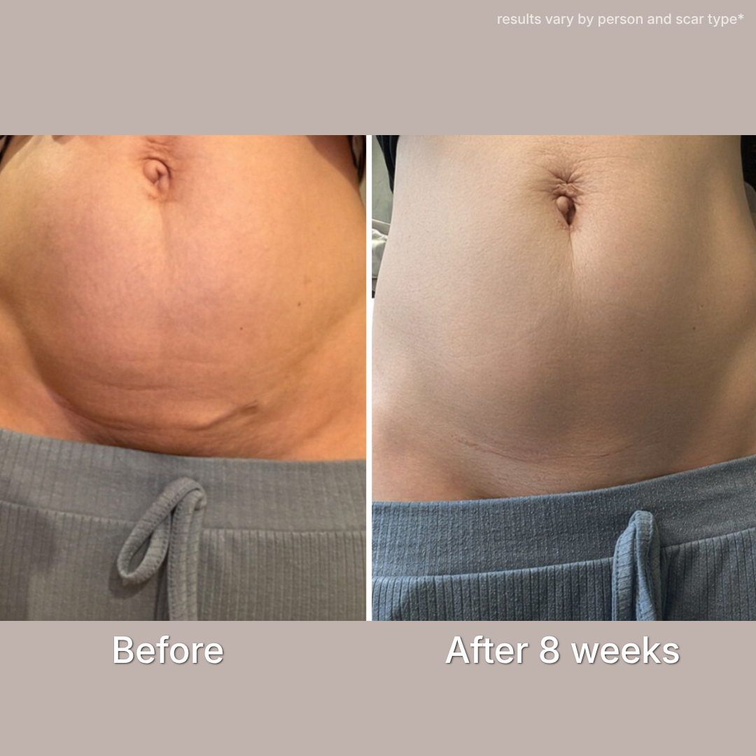 C-Section Scar Therapy Stick